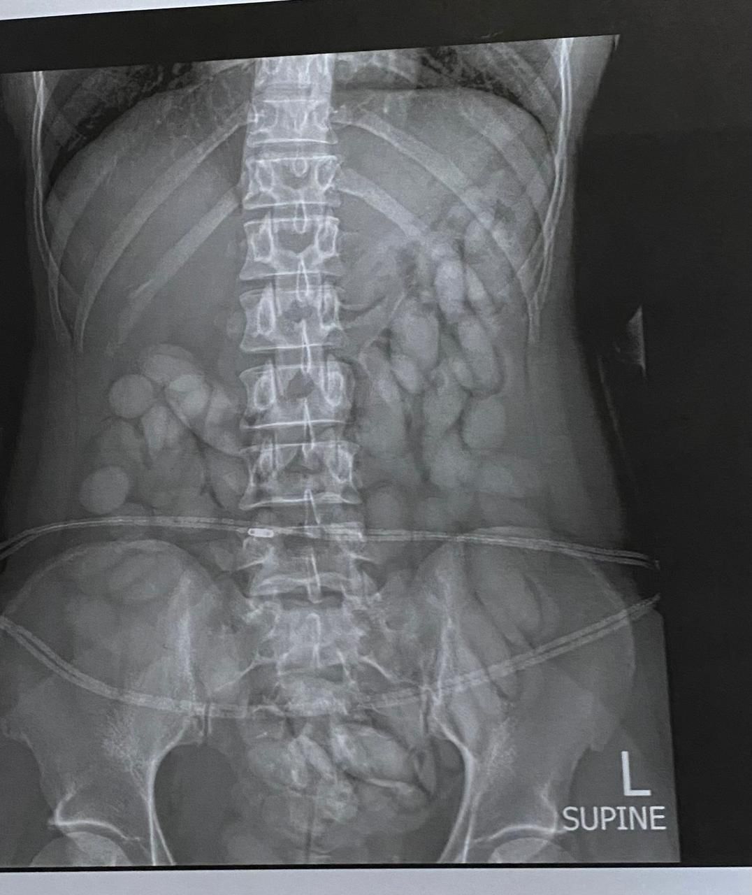 THE SHOCKING X-RAY PIC SHOWS WHERE DRUGS WERE HIDDEN IN HER STOMACH BEFORE SHE WAS ARRESTED AT OR TAMBO